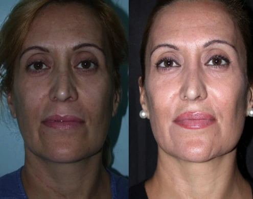 Caso real de cirugía de pómulos en Marbella antes y después, vista frontal paciente 1 | Clínica Renacimiento Marbella