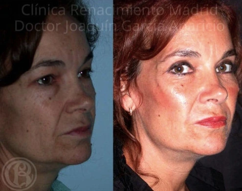 Antes y después de malarplastia en Marbella, armonización de pómulos paciente 2 | Clínica Renacimiento Marbella