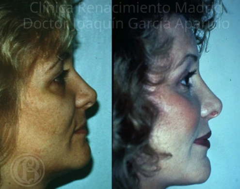 Caso real de pómulos / malarplastia en Marbella antes y después, perfil paciente 4 | Clínica Renacimiento Marbella