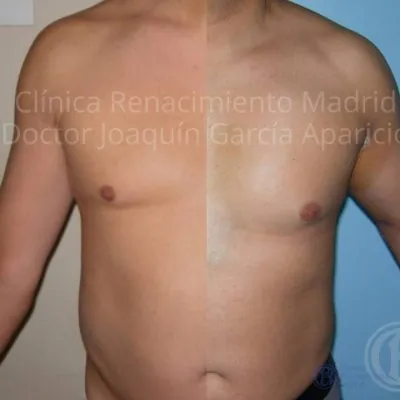 Caso real 5 de prótesis de bíceps en Marbella antes y después | Clínica Renacimiento Marbella