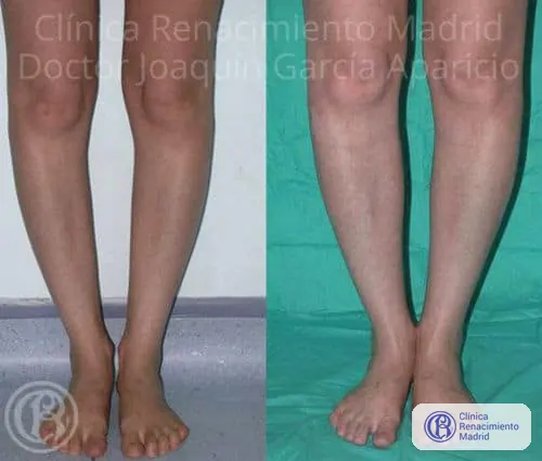 Caso real 1 de prótesis de gemelos en Marbella antes y después | Clínica Renacimiento Marbella