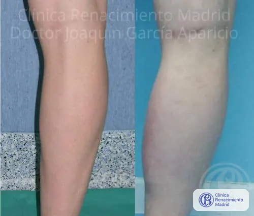 Caso real 2 de prótesis de gemelos en Marbella antes y después | Clínica Renacimiento Marbella