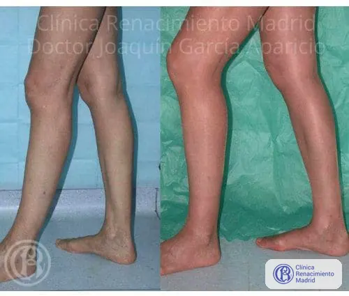 Caso real 3 de prótesis de gemelos en Marbella antes y después | Clínica Renacimiento Marbella