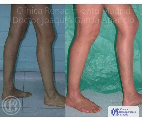 Caso real 4 de prótesis de gemelos en Marbella antes y después | Clínica Renacimiento Marbella