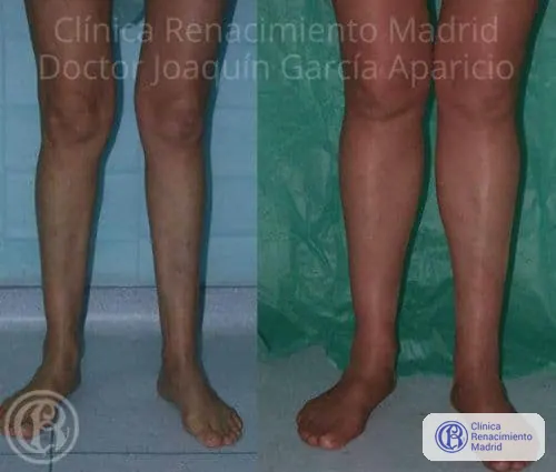 Caso real 6 de prótesis de gemelos en Marbella antes y después | Clínica Renacimiento Marbella