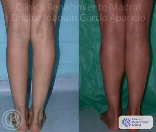 Caso real 7 de prótesis de gemelos en Marbella antes y después | Clínica Renacimiento Marbella