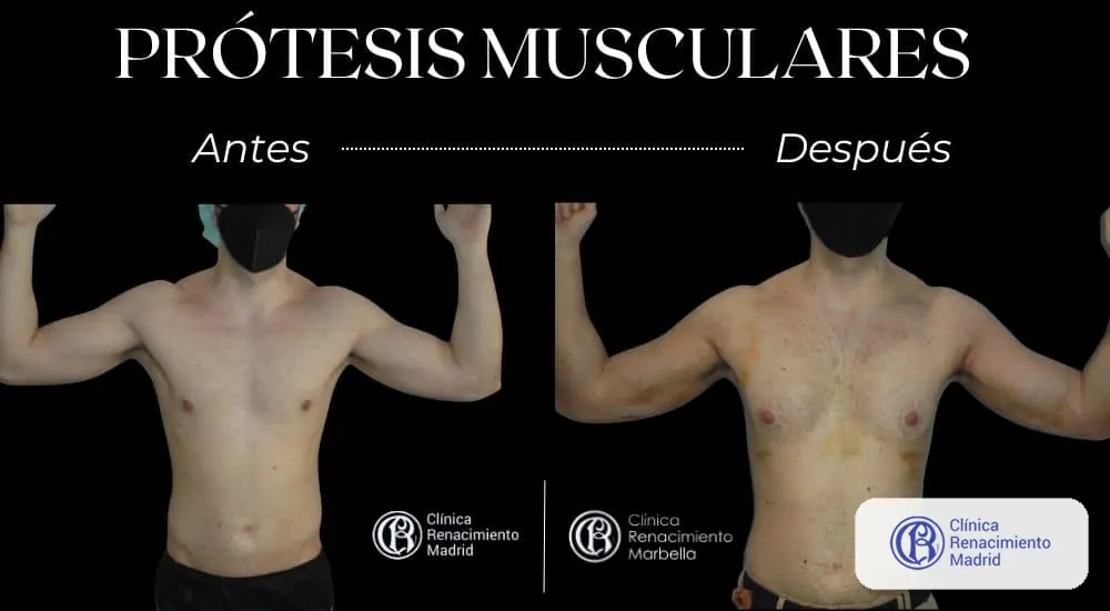 Caso real 2 de prótesis de pectorales en Marbella antes y después con brazos en flexión | Clínica Renacimiento Marbella