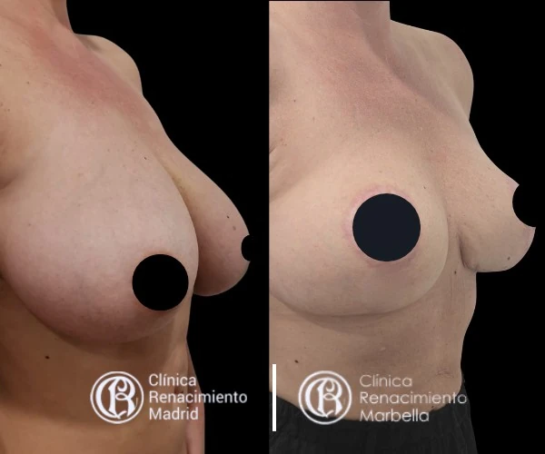Breast reduction case in Marbella before and after patient 1 | Clínica Renacimiento Marbella