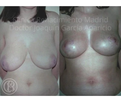 Breast reduction case in Marbella before and after patient 6 | Clínica Renacimiento Marbella