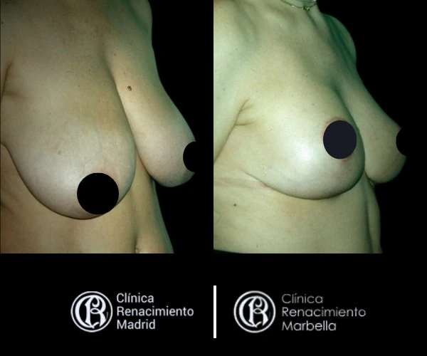 Breast reduction case in Marbella before and after patient 8 | Clínica Renacimiento Marbella