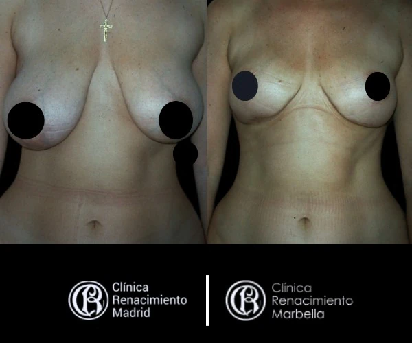 Breast reduction case in Marbella before and after patient 9 | Clínica Renacimiento Marbella