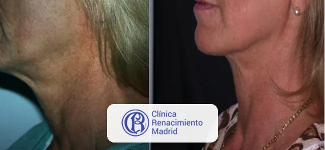 Caso real de rejuvenecimiento de cuello en Marbella antes y después paciente 1 | Clínica Renacimiento Marbella