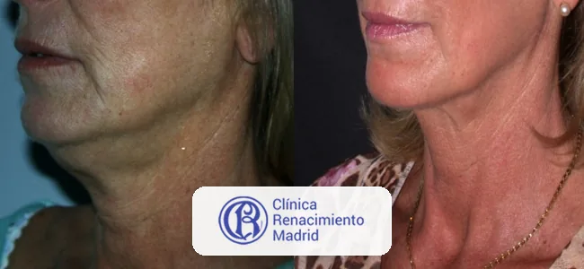 Antes y después de rejuvenecimiento de cuello en Marbella caso real 2 | Clínica Renacimiento Marbella