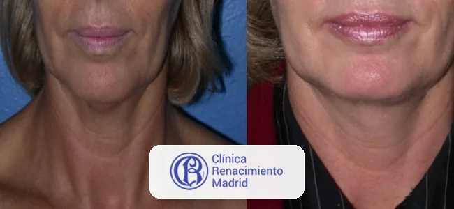 Rejuvenecimiento cervical en Marbella caso real antes y después 3 | Clínica Renacimiento Marbella