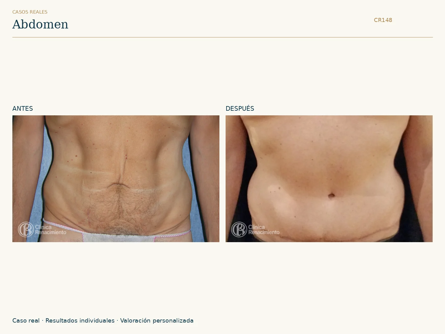 Abdomen / Abdominoplastia: antes y después, vista frontal. Clínica Renacimiento Marbella.