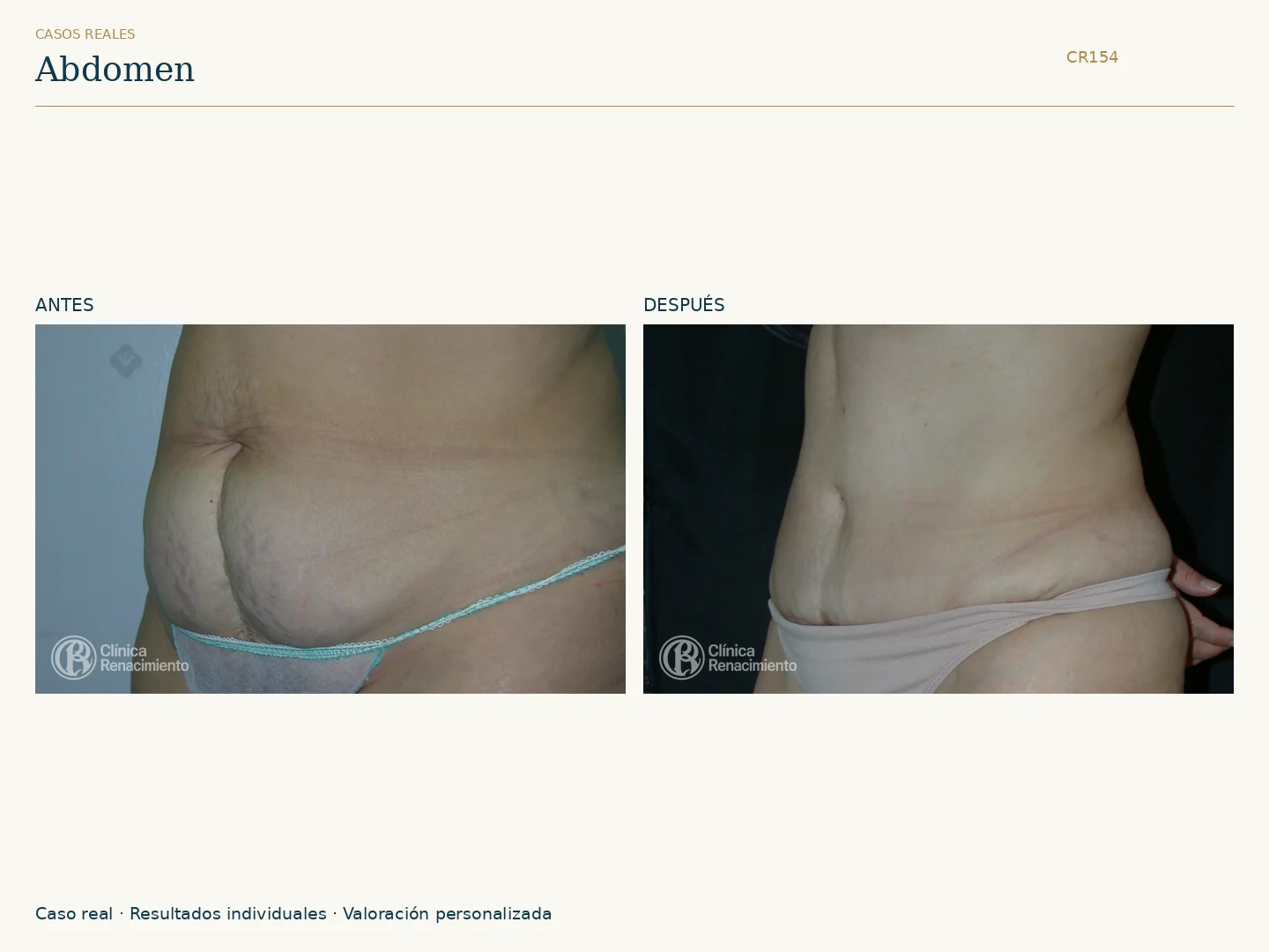 Abdomen / Abdominoplastia: antes y después, vista oblicua izquierda. Clínica Renacimiento Marbella.