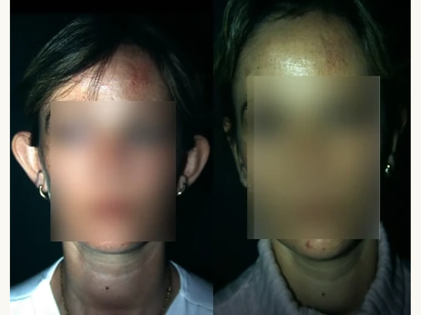 Orejas: Caso real de Otoplastia en Marbella antes y después paciente 5 | Clínica Renacimiento Marbella