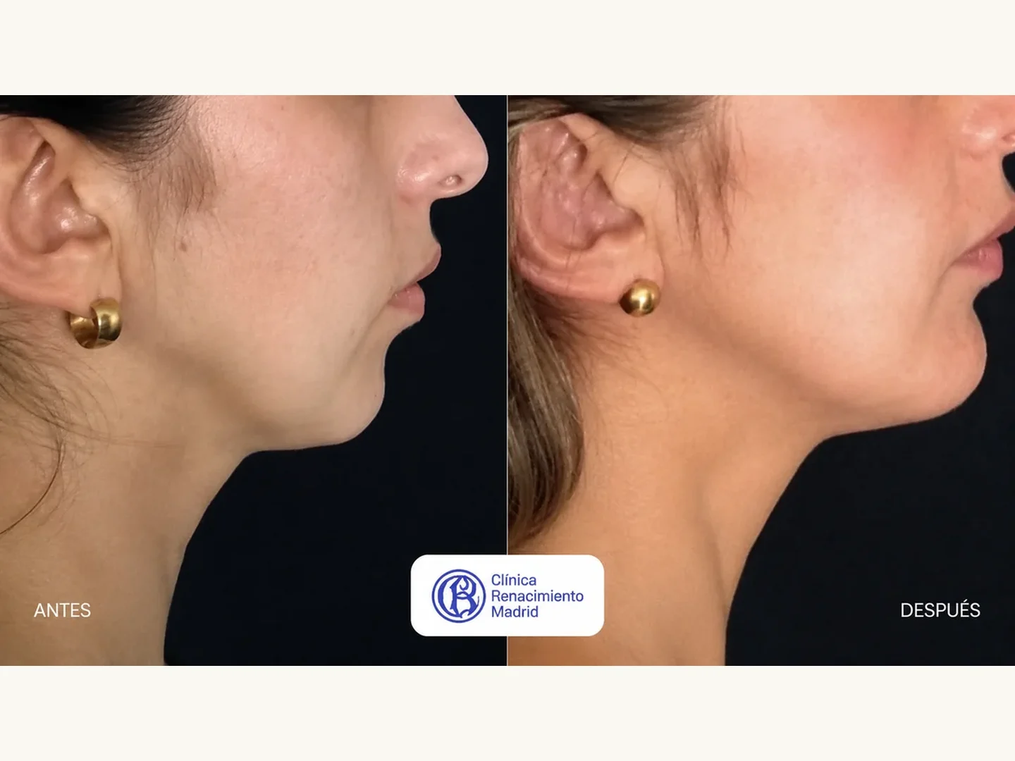 Caso real de cirugía de mentón en Marbella antes y después, perfil femenino con mejora de la línea mandibular | Clínica Renacimiento Marbella