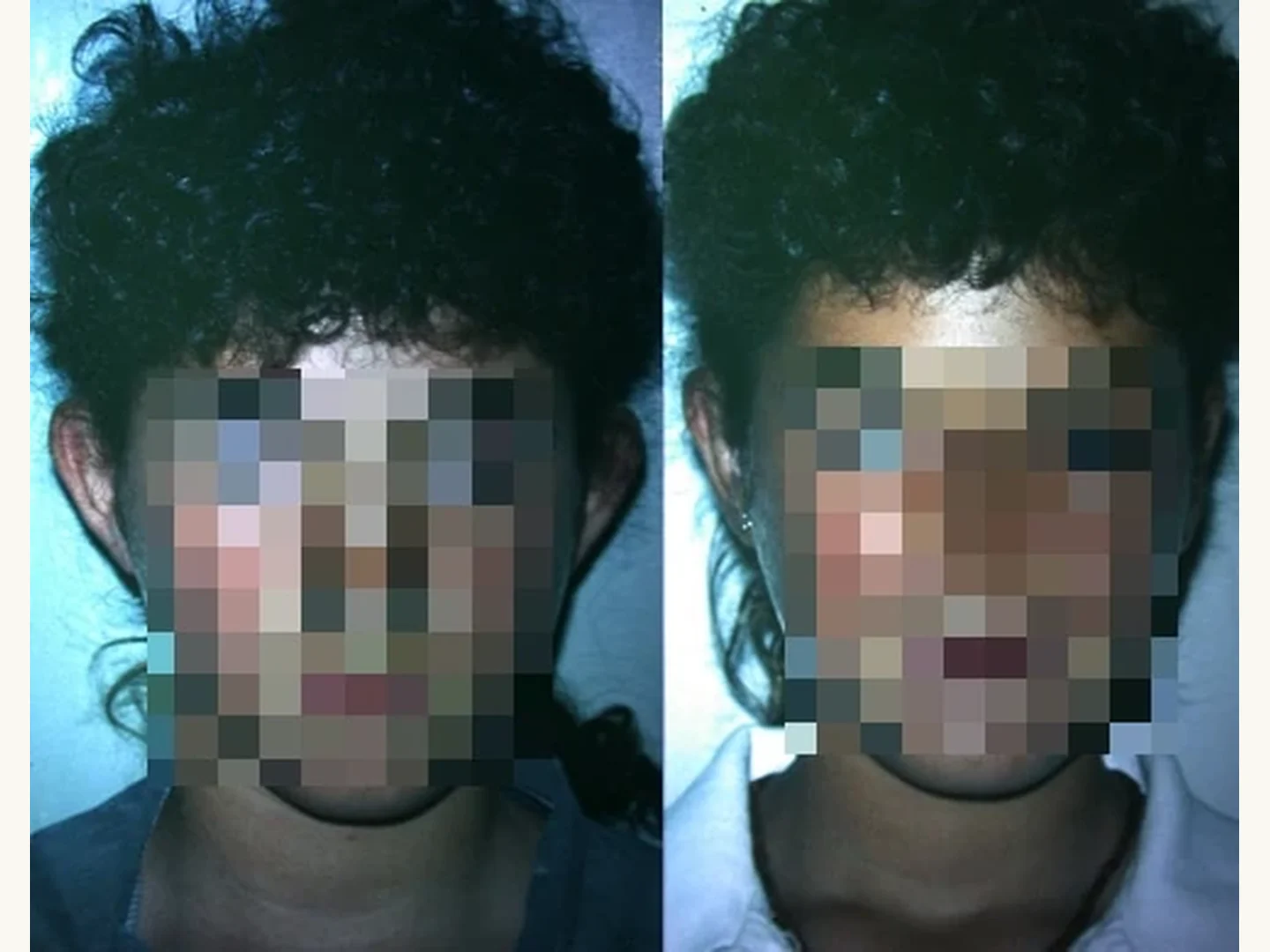 Orejas: Caso real de Otoplastia en Marbella antes y después paciente 8 | Clínica Renacimiento Marbella