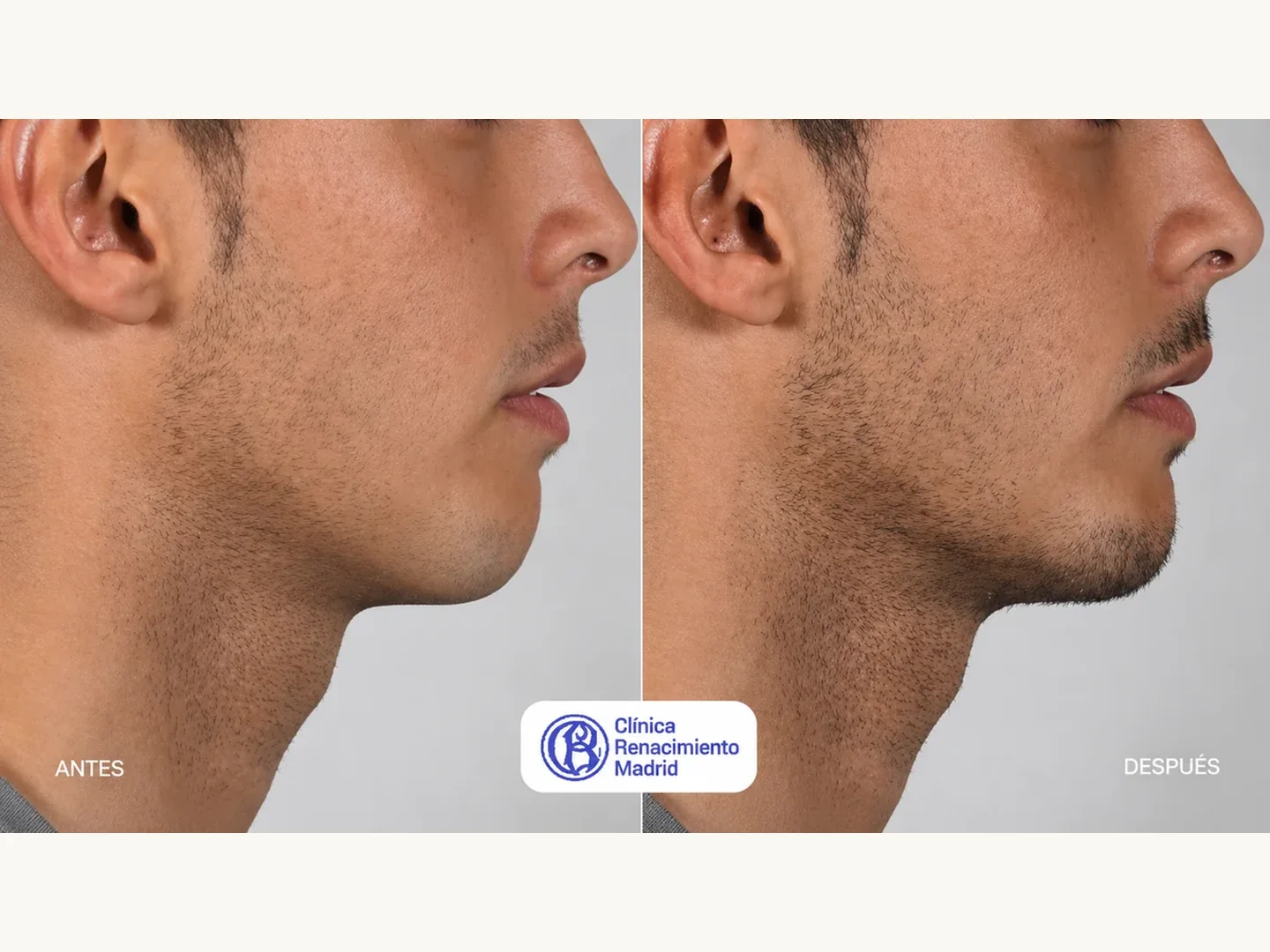 Caso real de mentoplastia masculina en Marbella antes y después, perfil y mentón proporcionado | Clínica Renacimiento Marbella