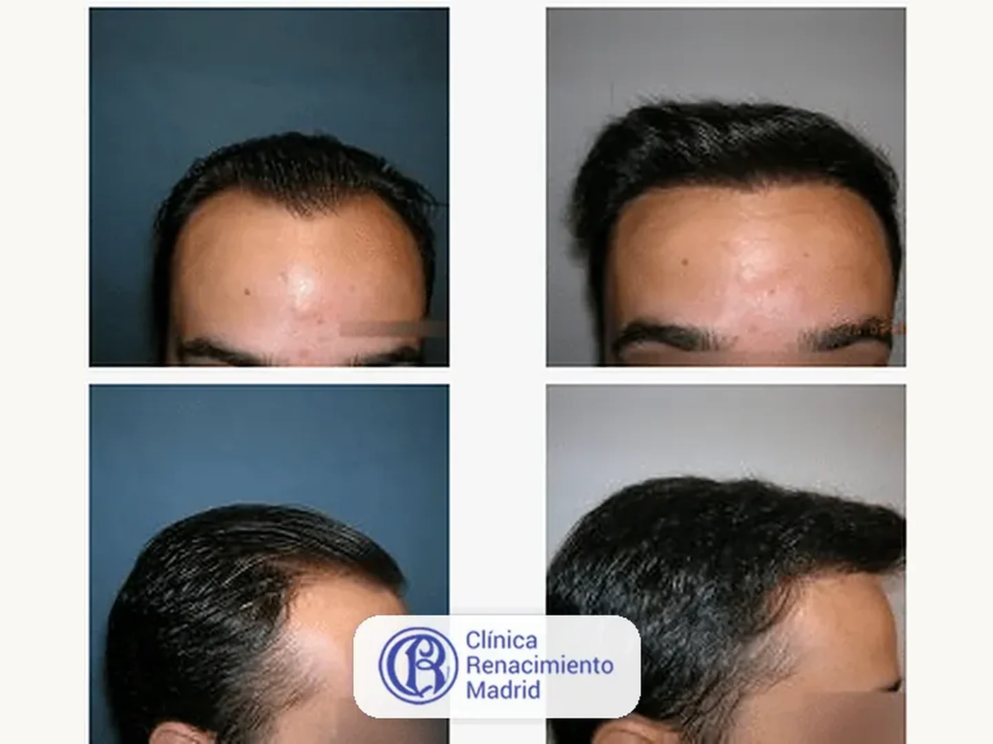 Caso real de implante de pelo en Marbella antes y después paciente 8 | Clínica Renacimiento Marbella
