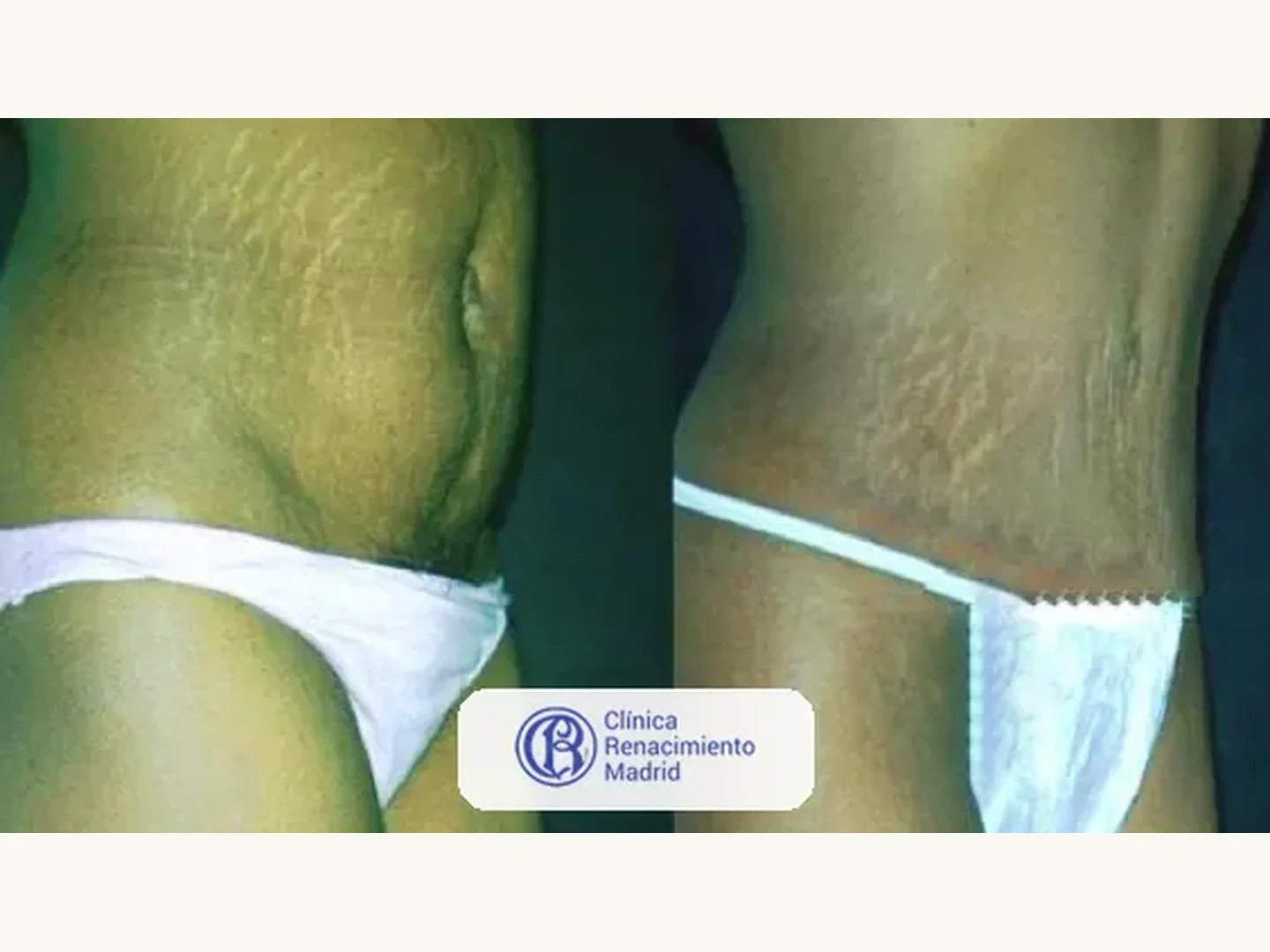 Abdomen: Caso real de abdominoplastia en Marbella antes y después paciente 5 | Clínica Renacimiento Marbella