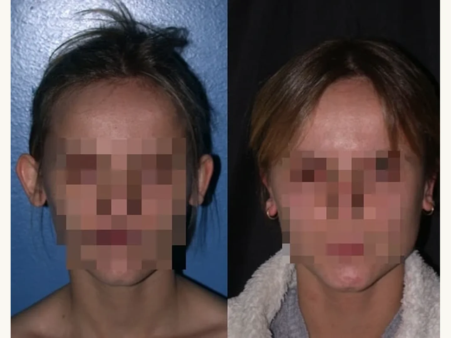 Orejas: Caso real de Otoplastia en Marbella antes y después paciente 7 | Clínica Renacimiento Marbella