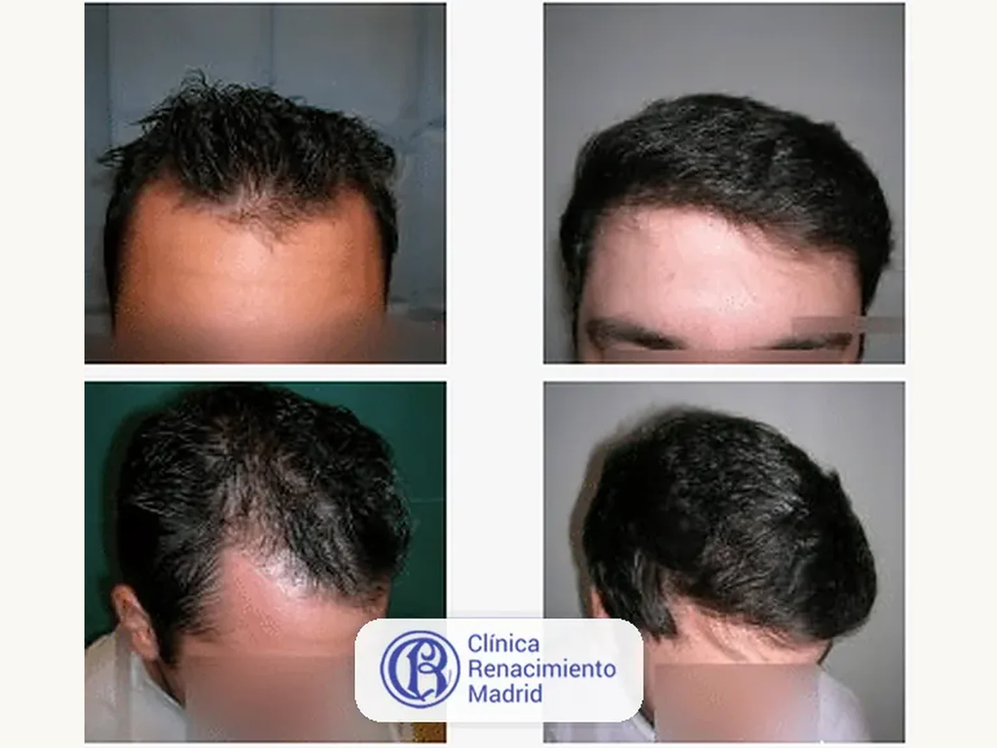 Caso real de implante de pelo en Marbella antes y después paciente 5 | Clínica Renacimiento Marbella