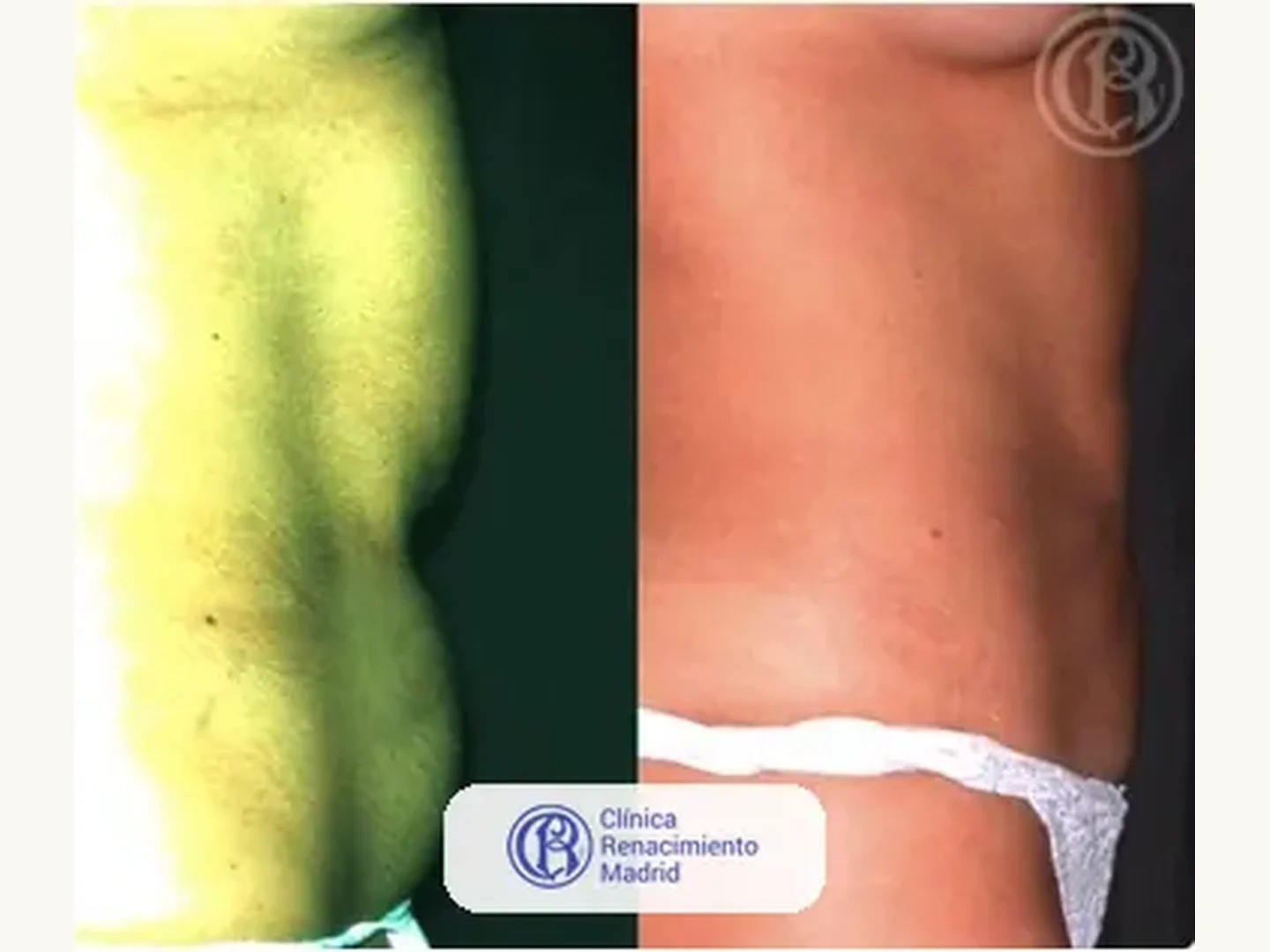 Lipoescultura integral HD: Caso real de lipoescultura y liposucción en Marbella antes y después caso 4 | Clínica Renacimiento Marbella