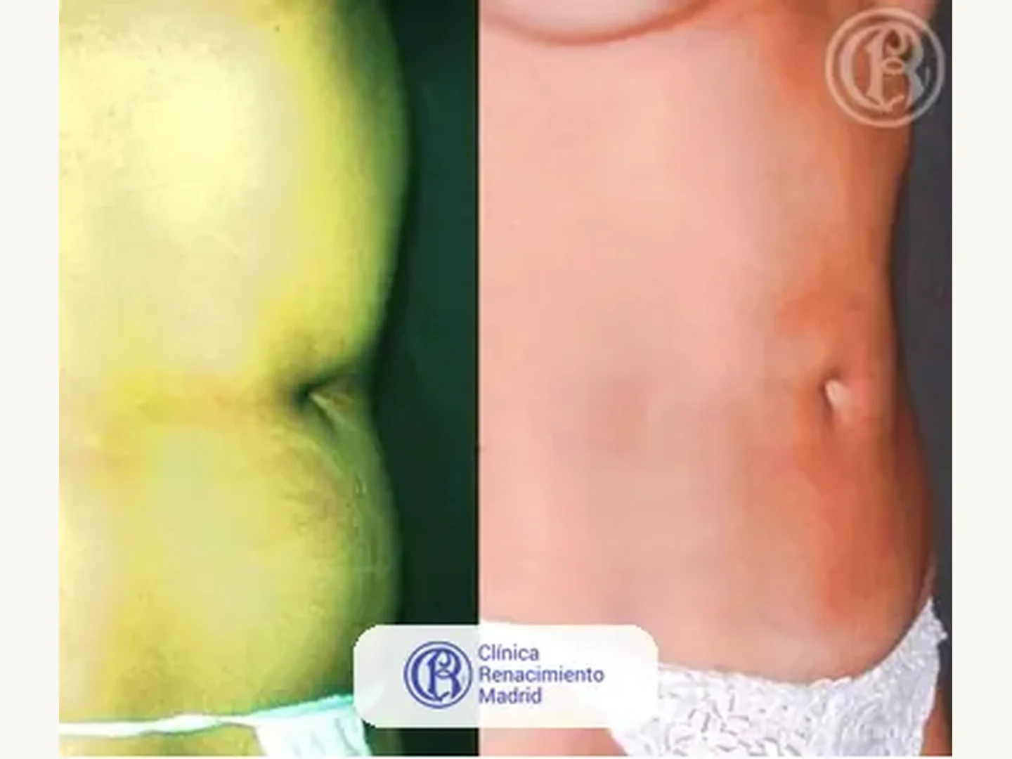 Lipoescultura integral HD: Caso real de lipoescultura y liposucción en Marbella antes y después caso 3 | Clínica Renacimiento Marbella