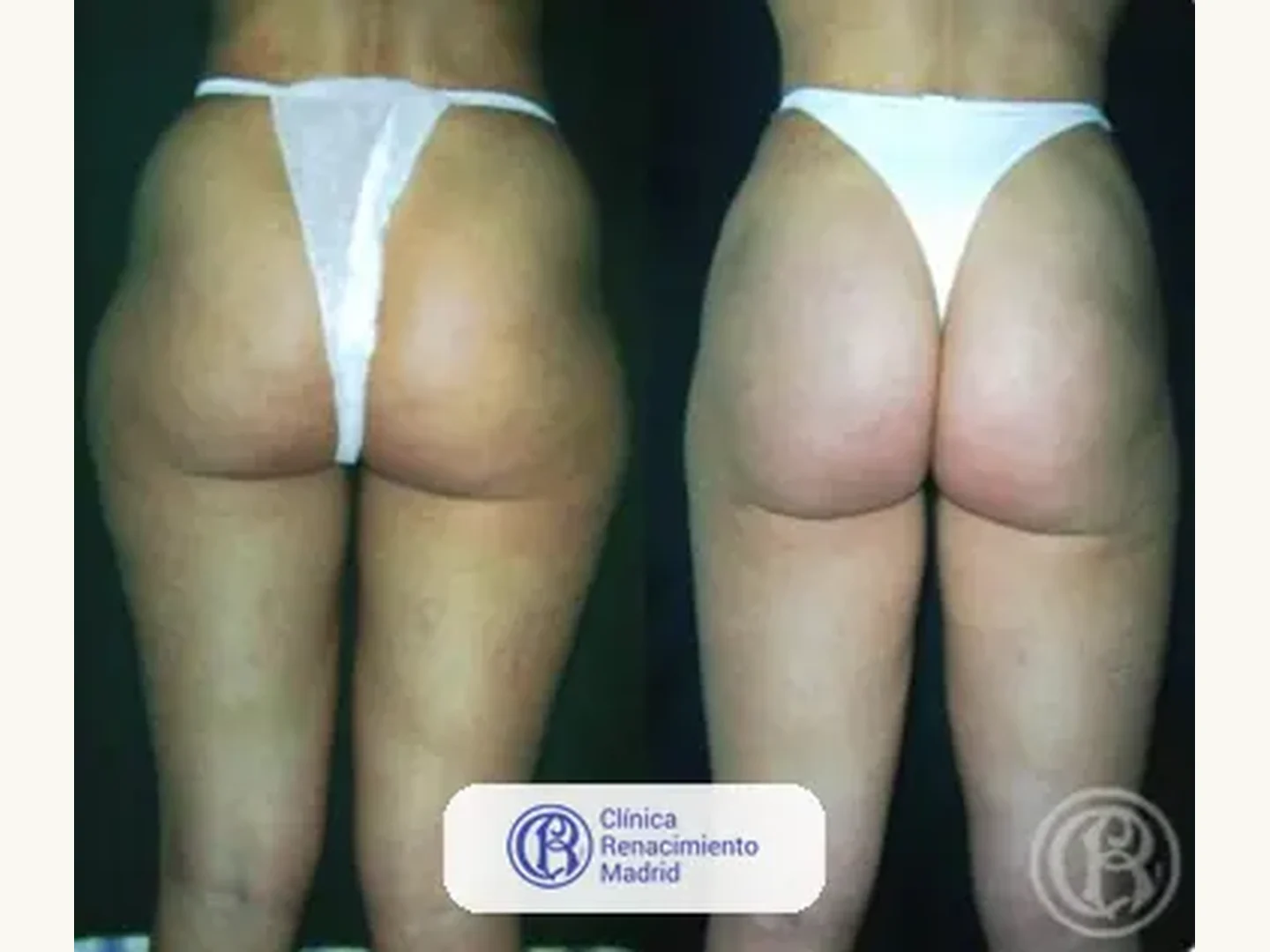 Lipoescultura integral HD: Caso real de lipoescultura y liposucción en Marbella antes y después caso 2 | Clínica Renacimiento Marbella