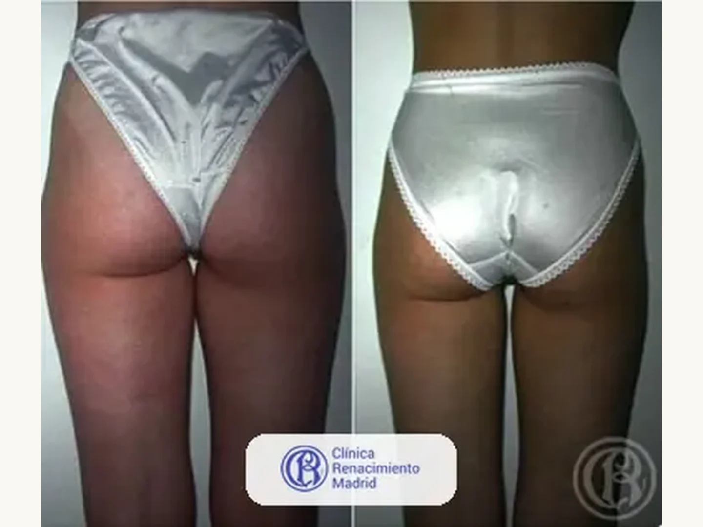 Lipoescultura integral HD: Caso real de lipoescultura y liposucción en Marbella antes y después caso 5 | Clínica Renacimiento Marbella