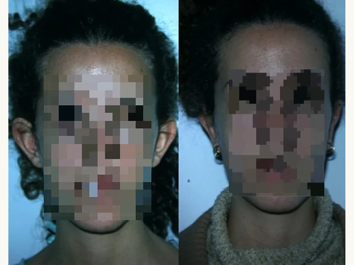 Orejas: Caso real de Otoplastia en Marbella antes y después paciente 6 | Clínica Renacimiento Marbella