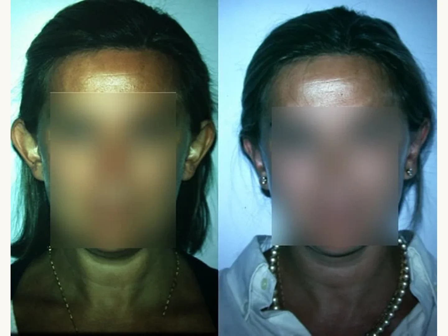 Orejas: Caso real de Otoplastia en Marbella antes y después paciente 4 | Clínica Renacimiento Marbella
