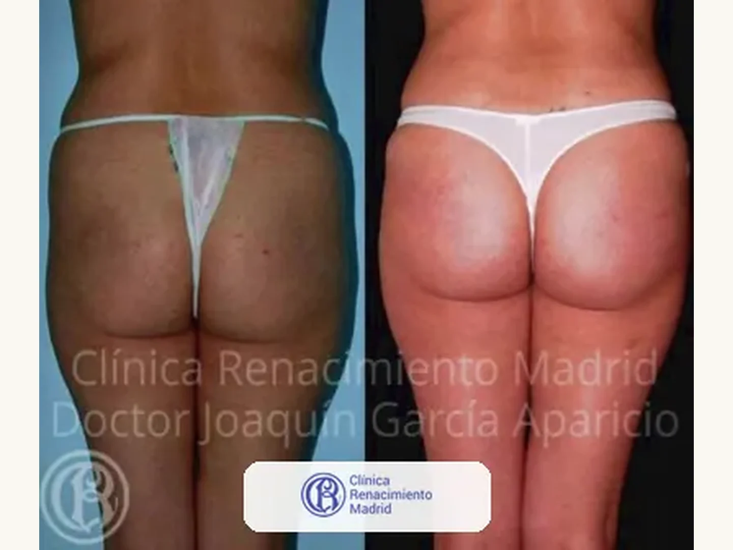 Caso real de prótesis de glúteos en Marbella antes y después paciente 9 | Clínica Renacimiento Marbella