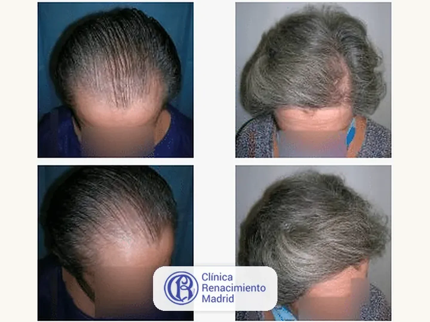 Caso real de implante de pelo en Marbella antes y después paciente 2 | Clínica Renacimiento Marbella