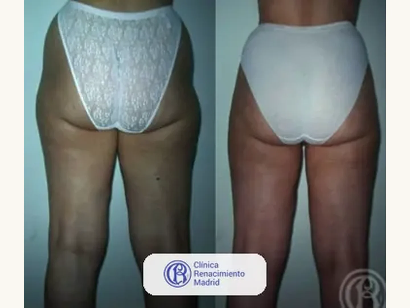 Lipoescultura integral HD: Caso real de lipoescultura y liposucción en Marbella antes y después caso 6 | Clínica Renacimiento Marbella
