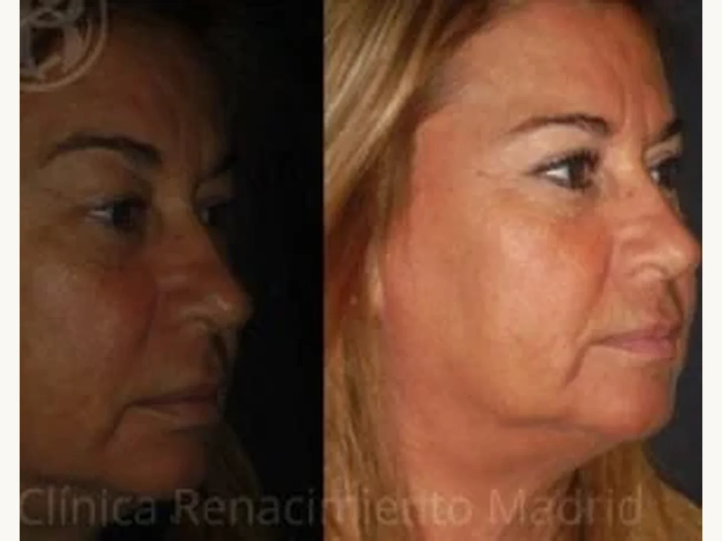Párpados: Caso real de blefaroplastia estética en Marbella antes y después paciente 7 | Clínica Renacimiento Marbella