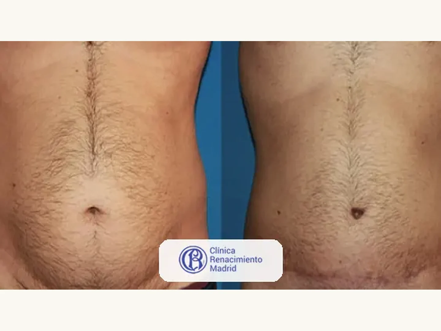 Abdomen: Caso real de abdominoplastia en Marbella antes y después paciente 6 | Clínica Renacimiento Marbella