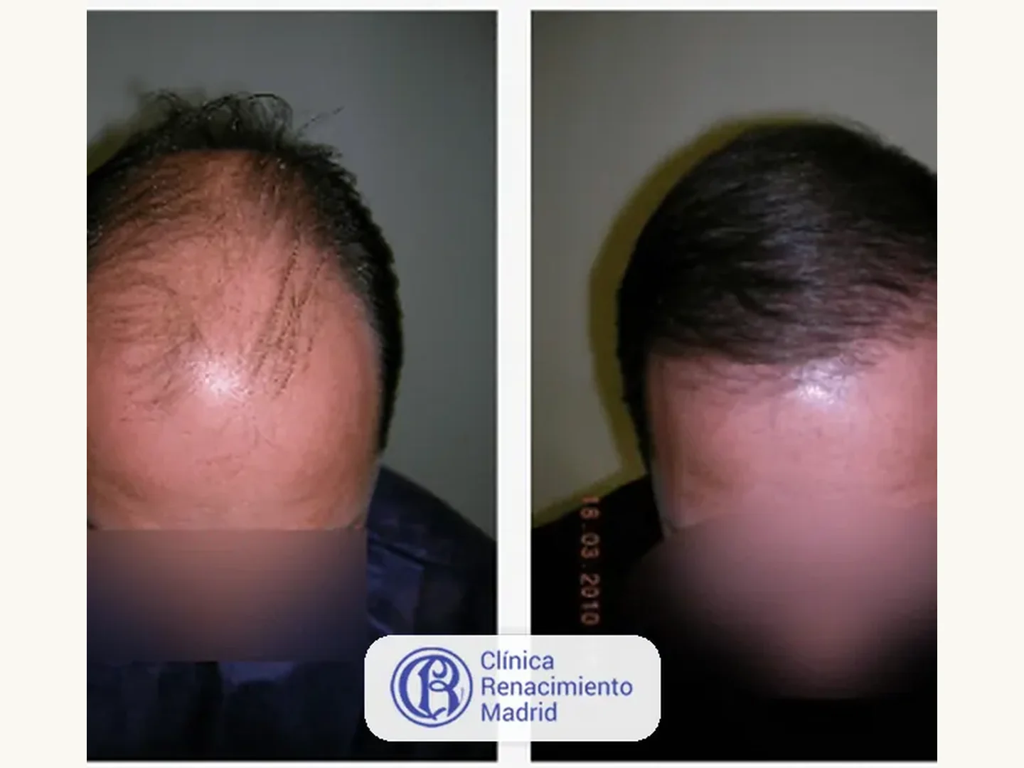 Caso real de implante de pelo en Marbella antes y después paciente 1 | Clínica Renacimiento Marbella