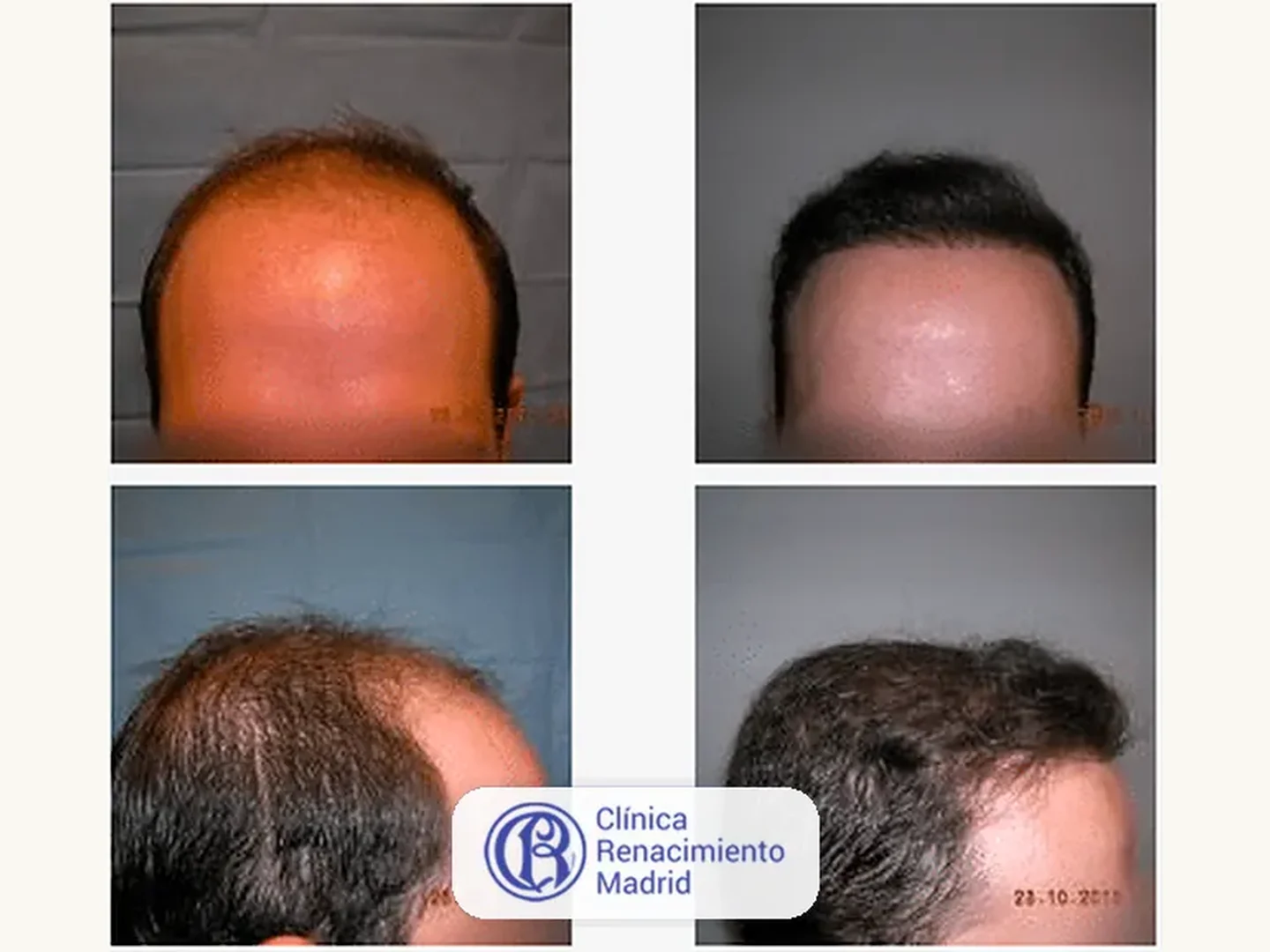 Caso real de implante de pelo en Marbella antes y después paciente 3 | Clínica Renacimiento Marbella