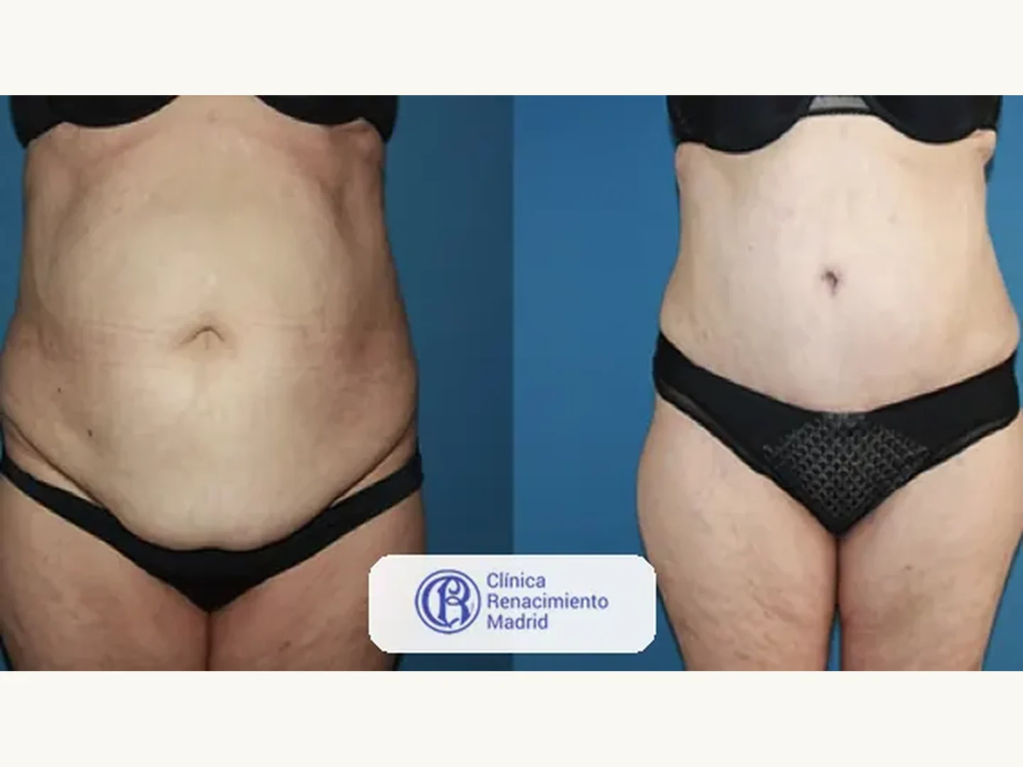 Abdomen: Caso real de abdominoplastia en Marbella antes y después paciente 1 | Clínica Renacimiento Marbella