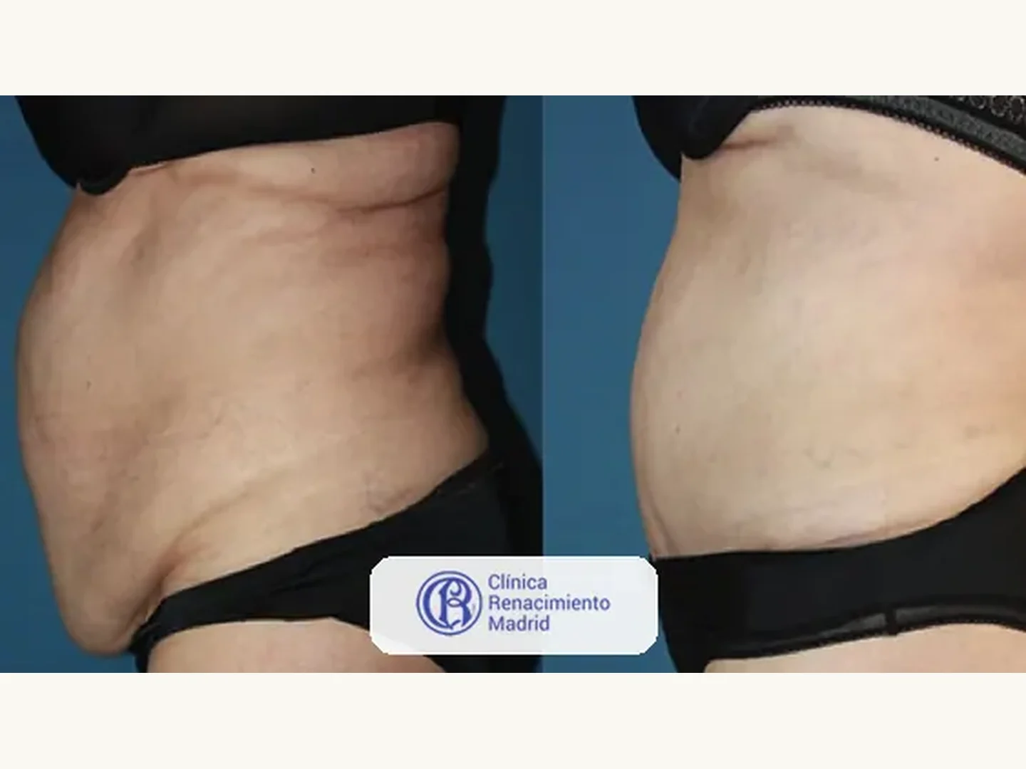 Abdomen: Caso real de abdominoplastia en Marbella antes y después paciente 2 | Clínica Renacimiento Marbella