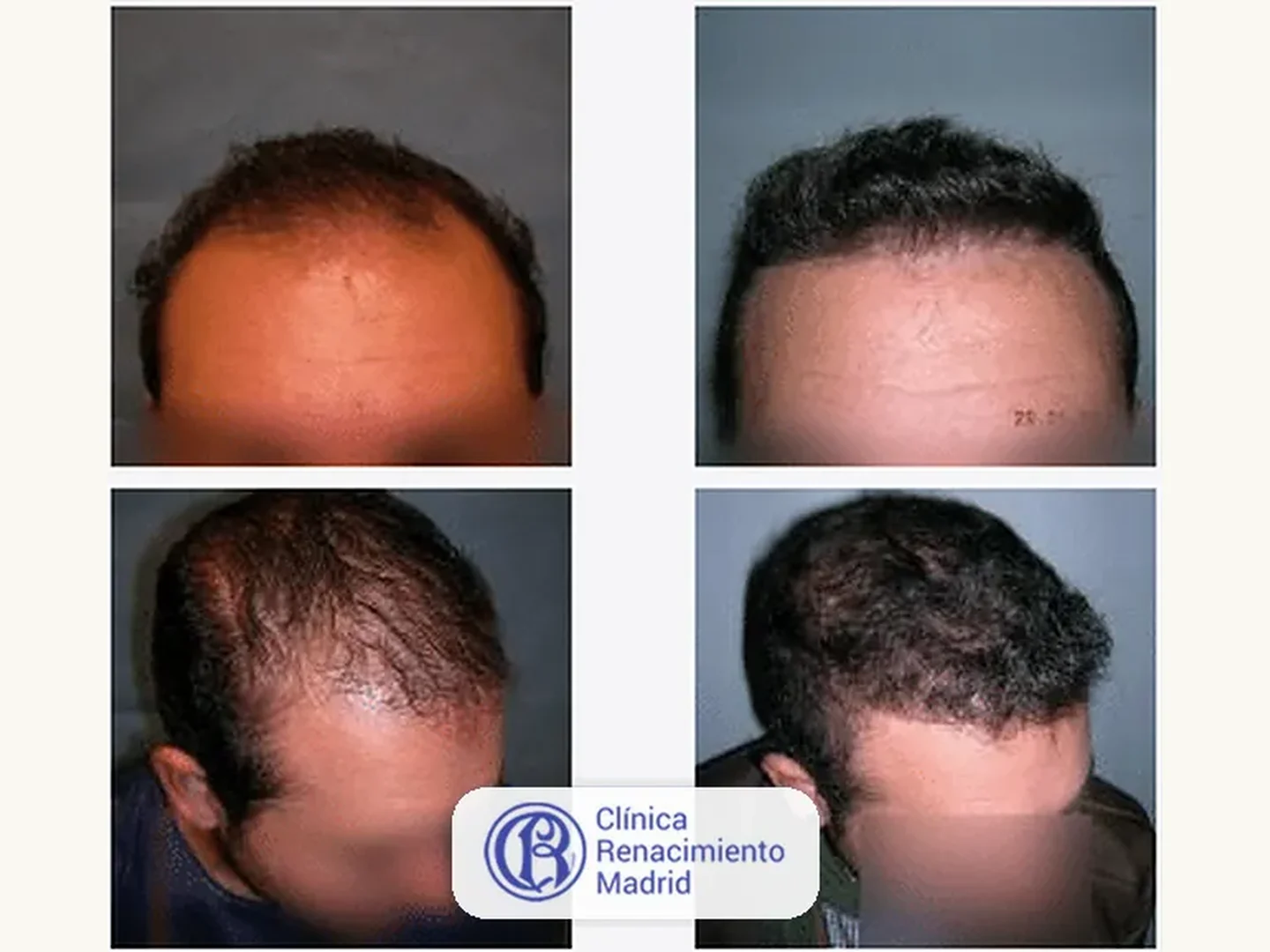 Caso real de implante de pelo en Marbella antes y después paciente 4 | Clínica Renacimiento Marbella