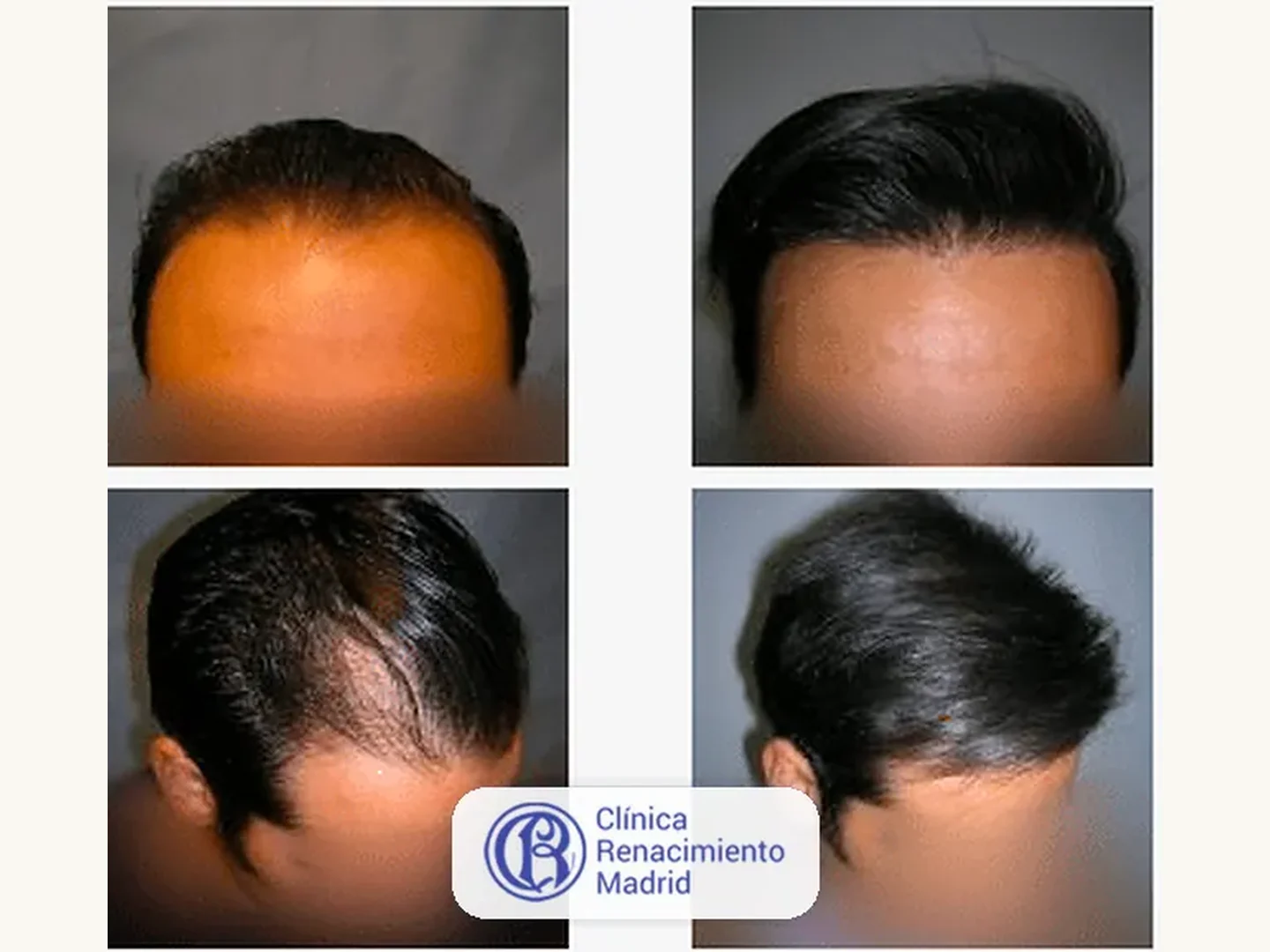 Caso real de implante de pelo en Marbella antes y después paciente 7 | Clínica Renacimiento Marbella