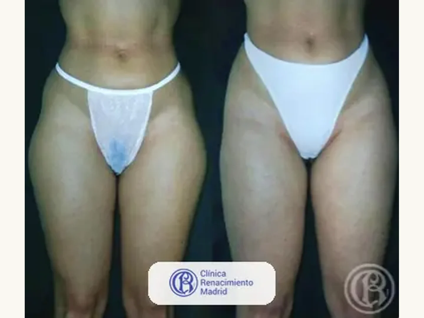 Lipoescultura integral HD: Caso real de lipoescultura y liposucción en Marbella antes y después caso 1 | Clínica Renacimiento Marbella