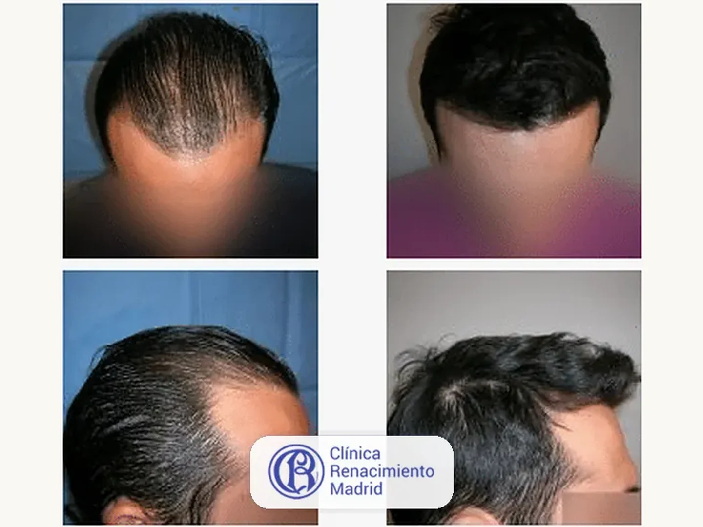 Caso real de implante de pelo en Marbella antes y después paciente 6 | Clínica Renacimiento Marbella