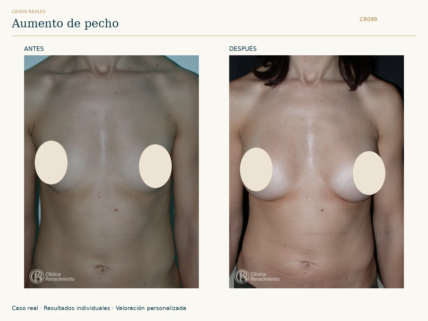 Aumento de senos / Mamoplastia de aumento: antes y después, vista frontal. Clínica Renacimiento Marbella.