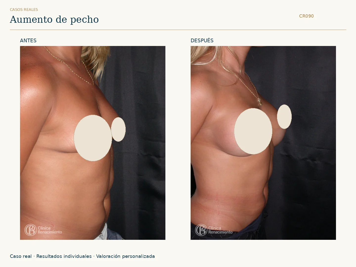 Aumento de senos / Mamoplastia de aumento: antes y después, vista oblicua derecha. Clínica Renacimiento Marbella.