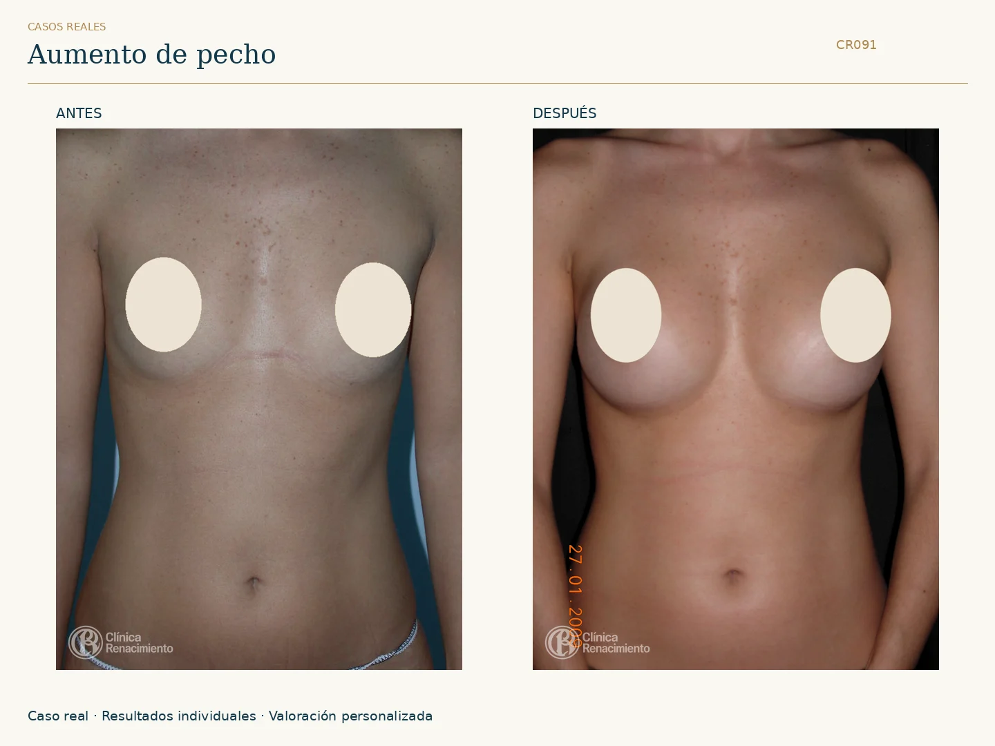 Aumento de senos / Mamoplastia de aumento: antes y después, vista frontal. Clínica Renacimiento Marbella.